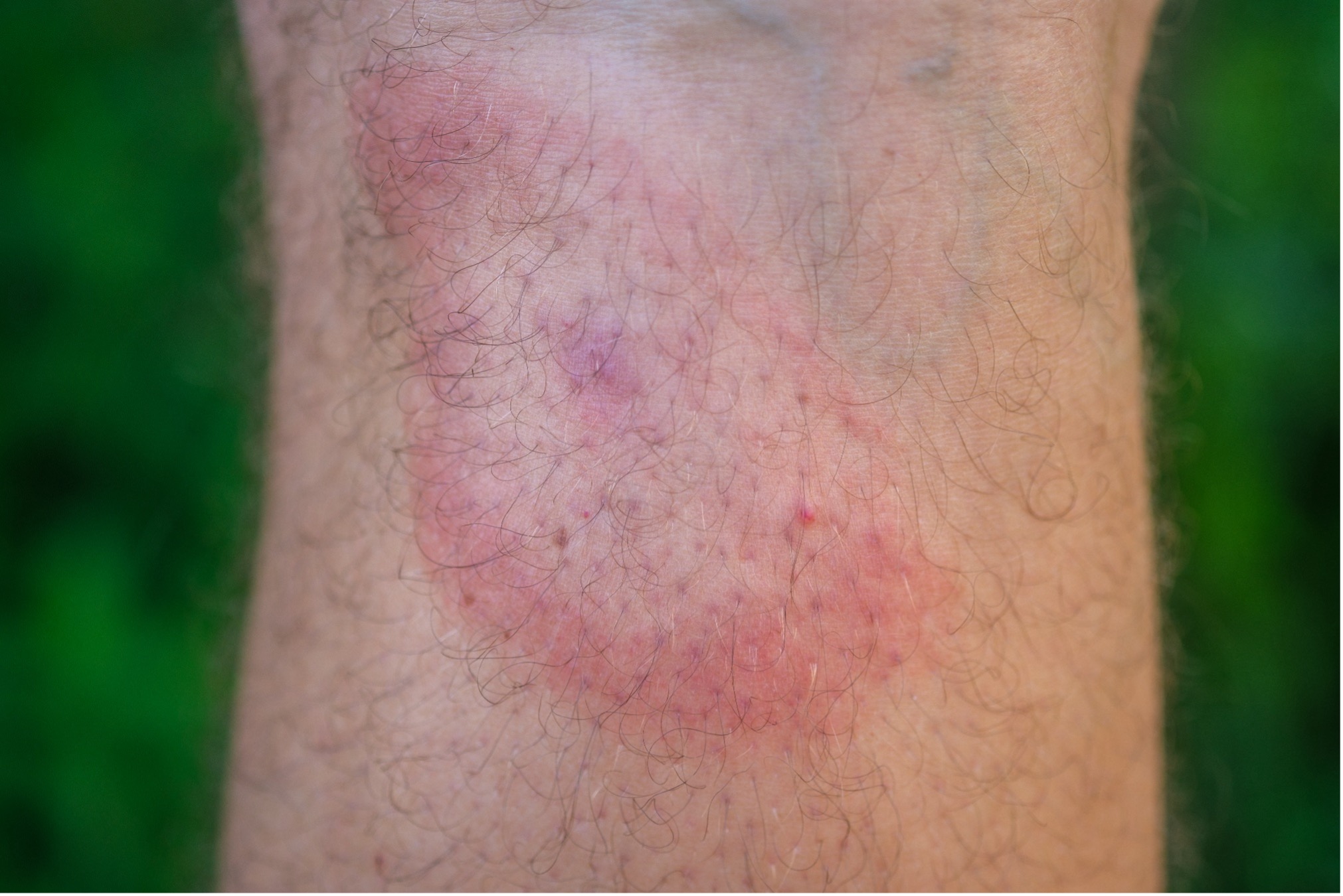 Мигрирующая эритема