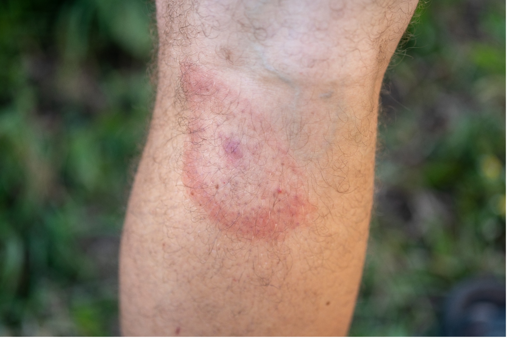 Мигрирующая эритема